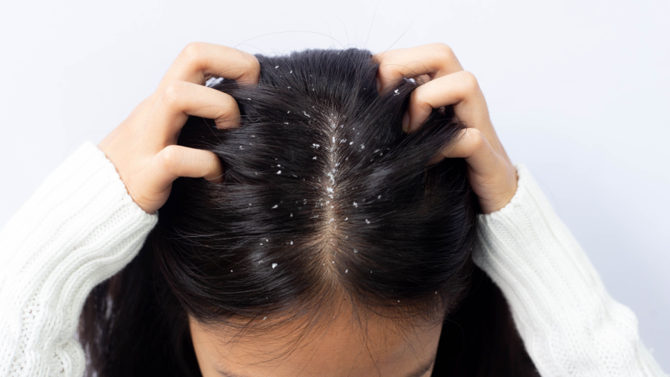 Seborrheic Dermatitis vs. Psoriasis: How to Tell the Difference and Treat Your Scalp Condition?