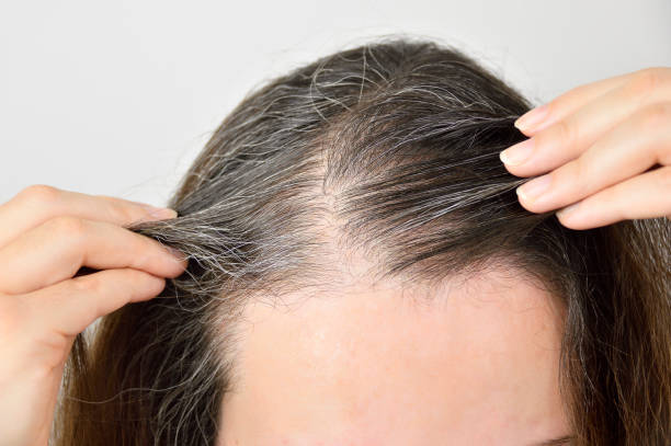 The Relationship Between Estrogen Deficiency and Hair Aging