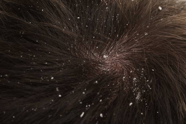 Dandruff and Scalp Microbiome: Ingredients and Insights for Scalp Health