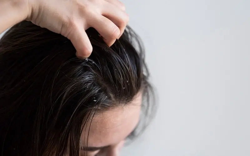 Decoding Dandruff: Understanding Causes, Treatments, and Prevention