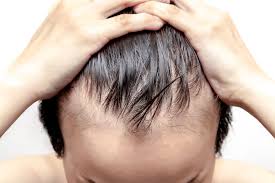 Hair Restoration Options for Men: Surgical and Non-Surgical Solutions