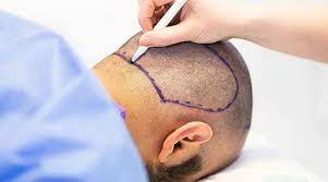 Debunking Hair Transplant Myths: Separating Fact from Fiction