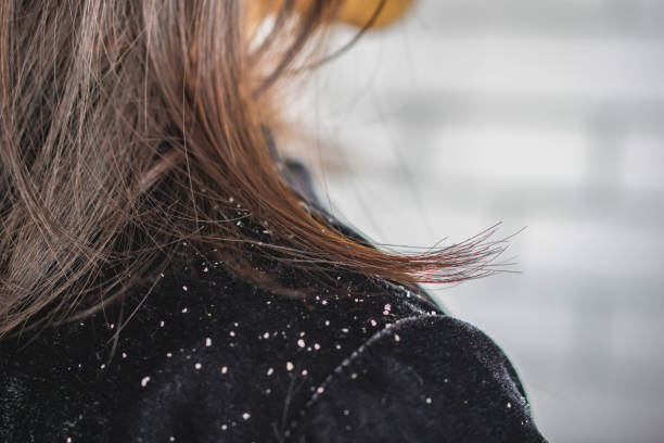 The Connection Between Diet and Dandruff: Foods to Avoid